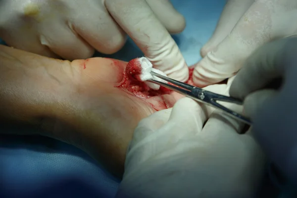 Hand surgery and swab
