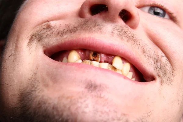 Bad teeth