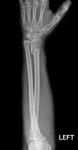 Fracture shaft of radius & ulnar bone, x-ray film