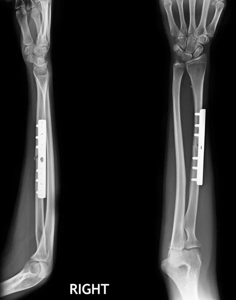 Fracture shaft of radius & ulnar bone, x-ray film