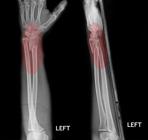 Fracture shaft of radius & ulnar bone, x-ray film