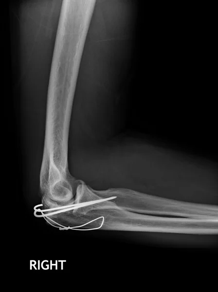 Fracture Elbow, forearm x-rays image showing plate and screw fixation