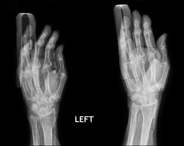 X-Ray Hand.