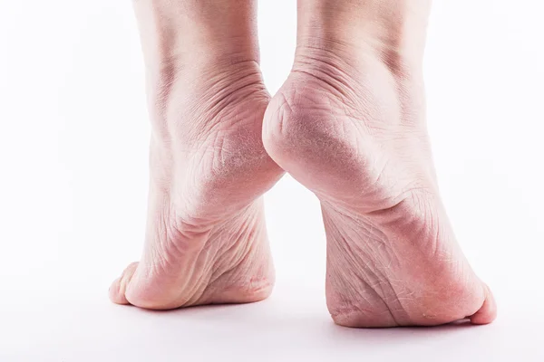 Dry heels woman on a white background closeup