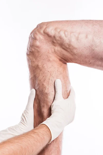 Doctor in medical gloves examines a person with varicose veins o