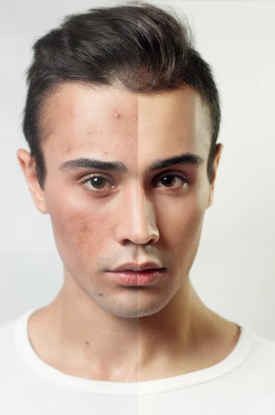 Before and after cosmetic operation. Young pretty man portrait