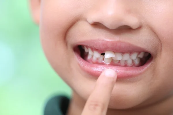 Little boy with teeth broken and rotten