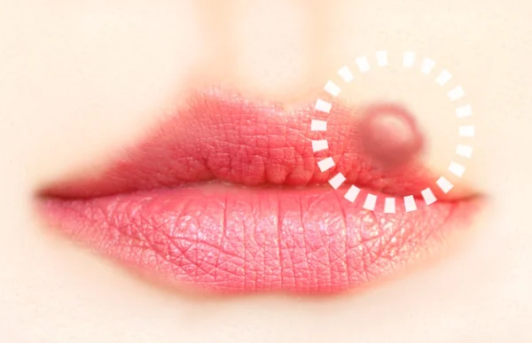 Closeup of a common cold sore virus herpes.