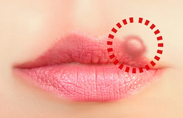 Closeup of a common cold sore virus herpes.