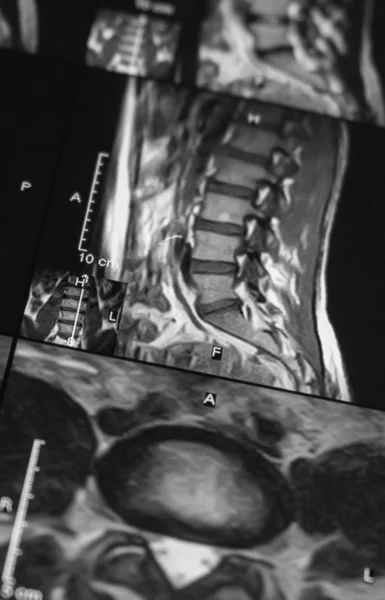 MRI spine