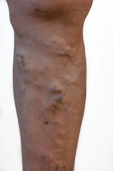 Varicose veins on a leg.