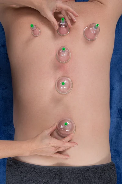 Acupuncture therapist removing a cupping glass from the back