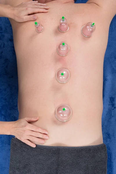 Top view of Acupuncture therapist removing a cupping glass