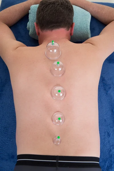 Close up of a Medical cupping therapy on man body