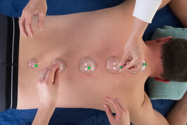 Multiple vacuum cup of medical cupping therapy on man back