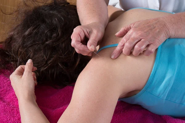 Bright caucasian woman receiving an acupuncture treatment