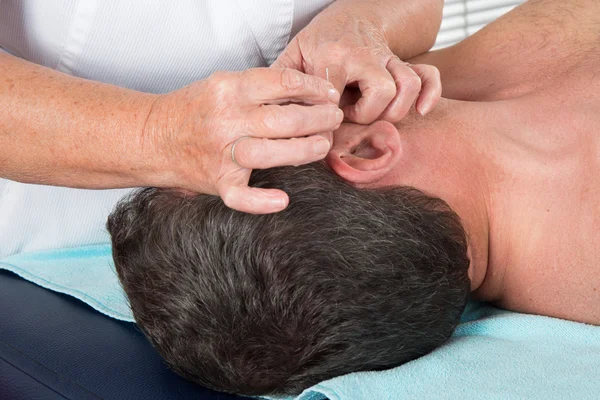 Man in an acupuncture therapy at the health spa