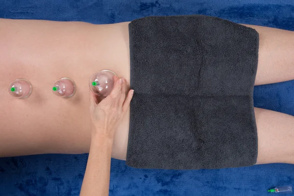 Caucasian male laying and get a cupping therapy