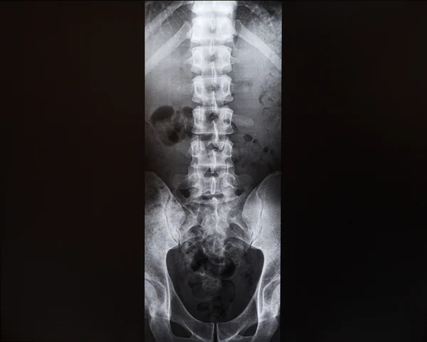 X-ray of the spine and pelvis. Medicine
