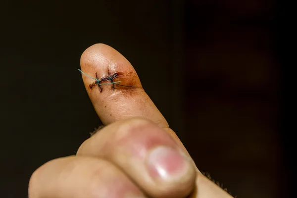 On the finger are two non-absorbable surgical sutures.