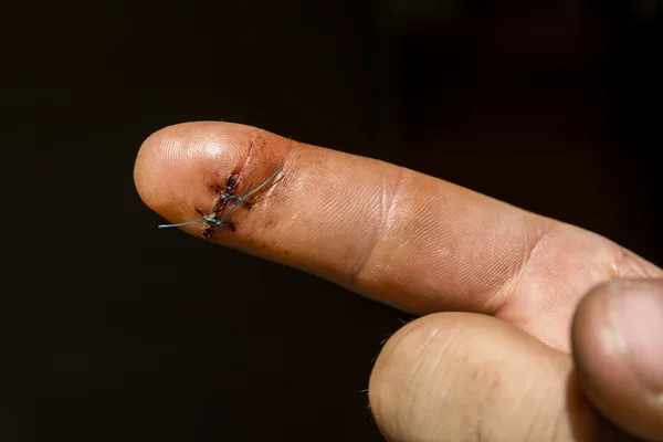 Surgical suture on the finger.