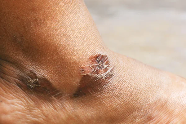 Burn skin of foot