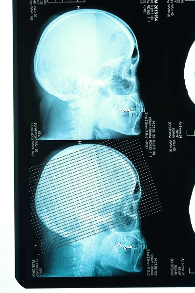 Profile view with a human skull X Ray