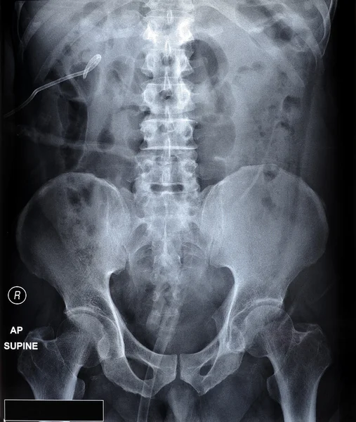 X ray film of kidney stones with ureteric stent