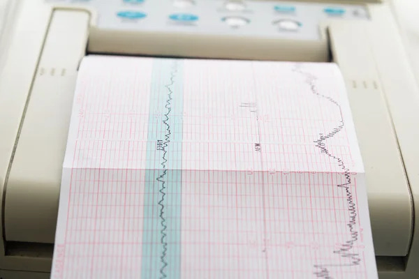 Printing of cardiogram report coming out from Electrocardiograph in labour ward