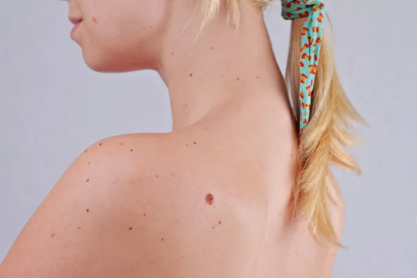 Checking benign moles : Woman with birthmarks on her back Skin tags removal