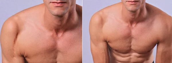 Laser scar removal before and after. Attractive Man with scar on his shoulder