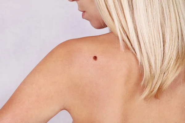 Young woman looking at birthmark on her back, skin. Checking benign moles