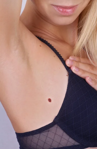 Young woman holding her arms up and showing underarms, armpit. Birthmark on skin. Checking benign moles