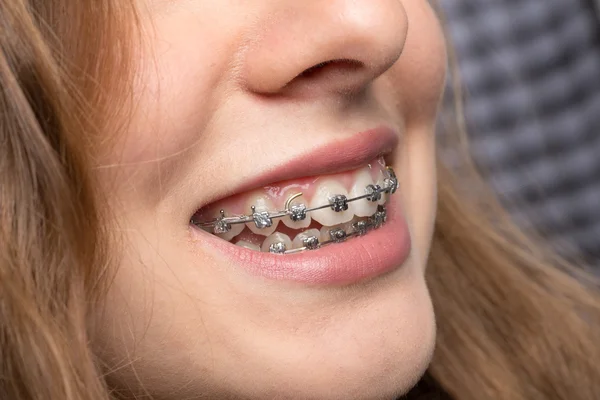 Teenager mouth with dental brace