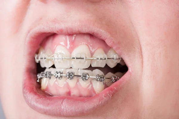 Mouth with a dental brace