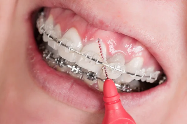 Cleaning a mouth with a dental brace