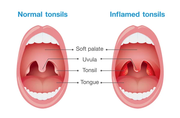 Normal tonsils and inflamed tonsils