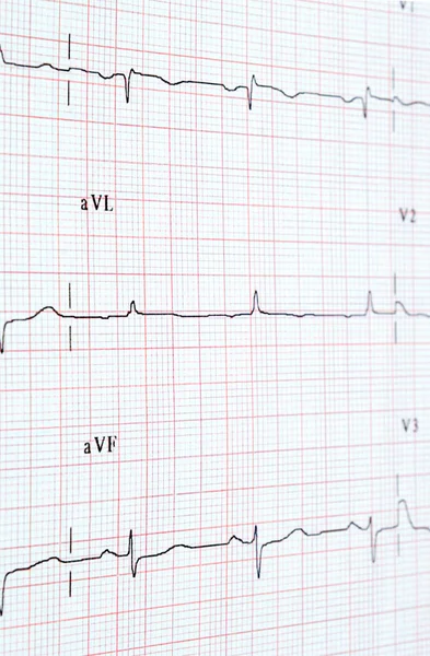 Heart rate on medical print out