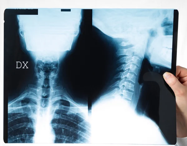 X-ray cervical