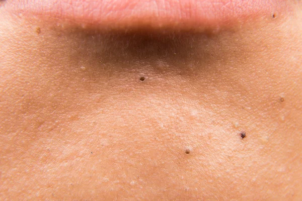 Closeup of pimple blackheads below the lips on jaw of a teenager