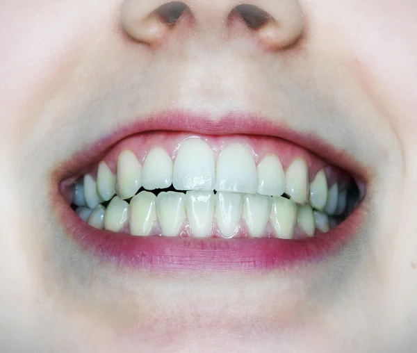 Natural teeth in a half opened woman\'s mouth