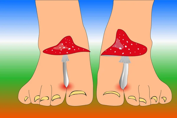 Amanita mushrooms between the toes feet imitating toes fungus