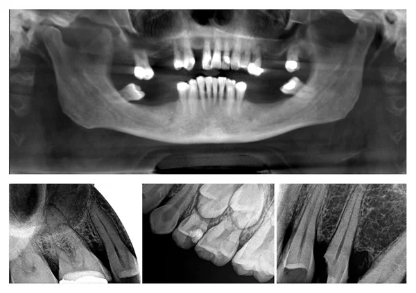 Dental x-ray collage