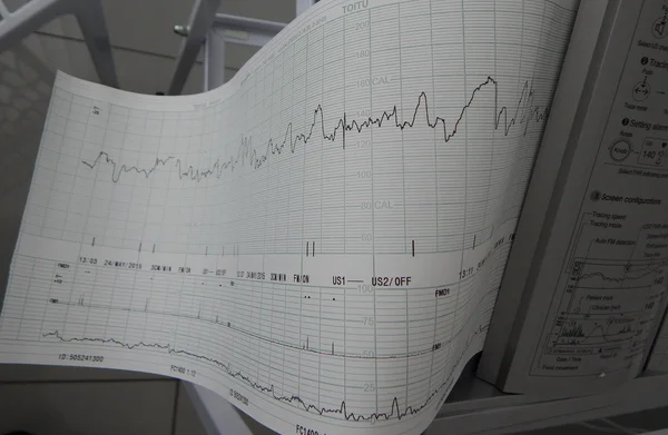 Cardiograph fixing and printing graphs of heart rate