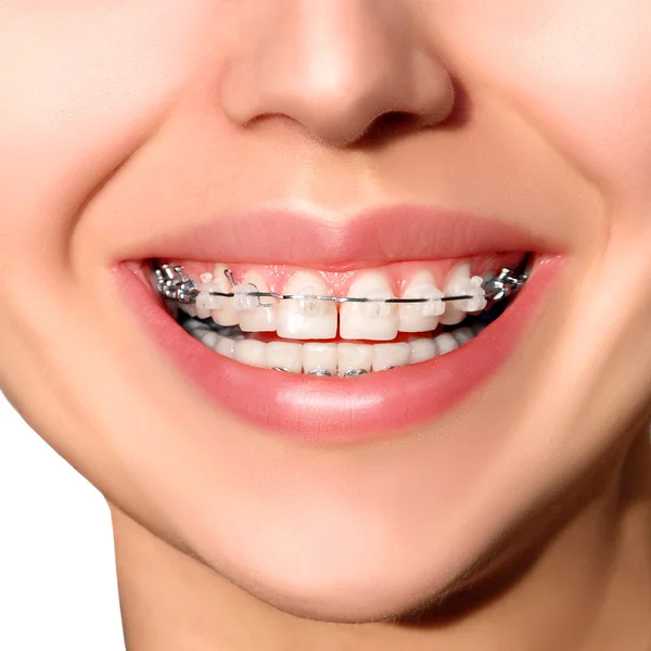 Closeup Ceramic and Metal Braces on Teeth. Broad Smile with Self-ligating Brackets.