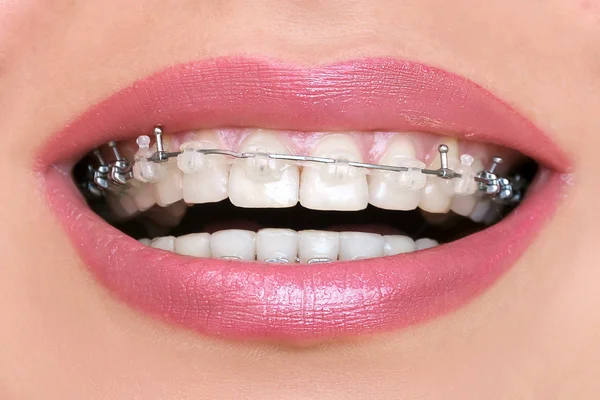 Teeth with Braces close up