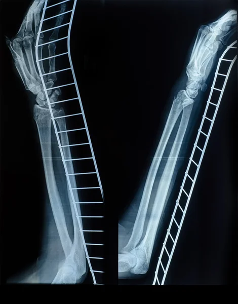 X-Ray image of human hand and arm after a fracture on the metal