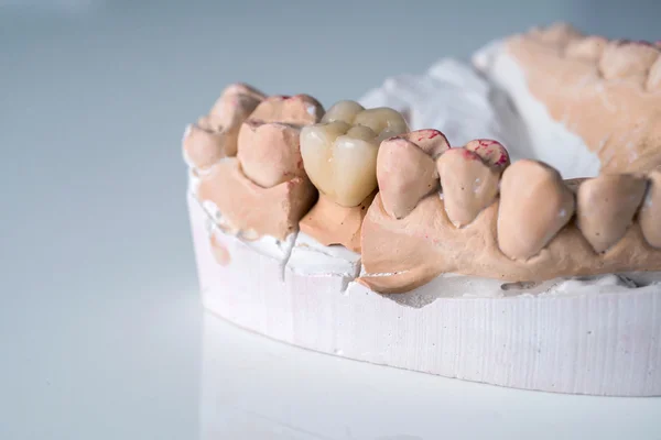Ceramic crowns in dental laboratory on white