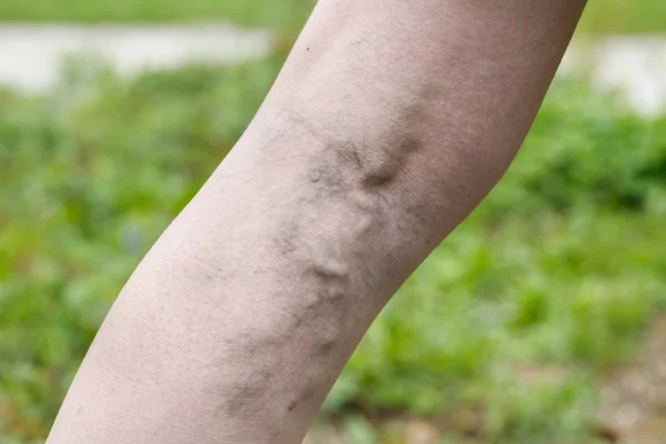 Woman with painful varicose and spider veins on her legs