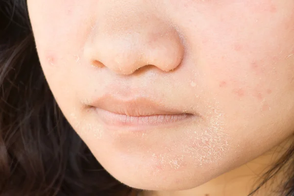 Cracks on the girl\'s face from acne.